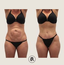 Instagram post by @bodybyraviplasticsurgery