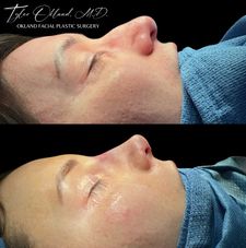 Instagram post by @okland.facial.plastic.surgery